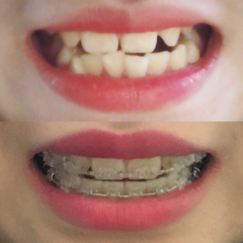 교정 2년반째인데 변화 보고 갈 익인~!~!40 | 인스티즈