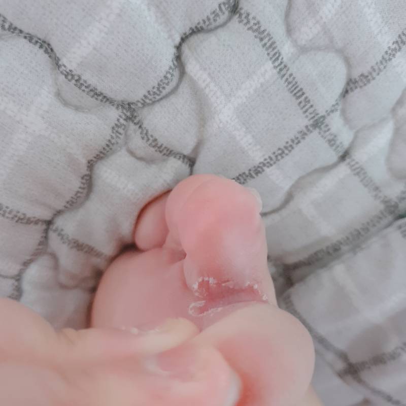 이거 무좀이야? (혐오주의) | 인스티즈