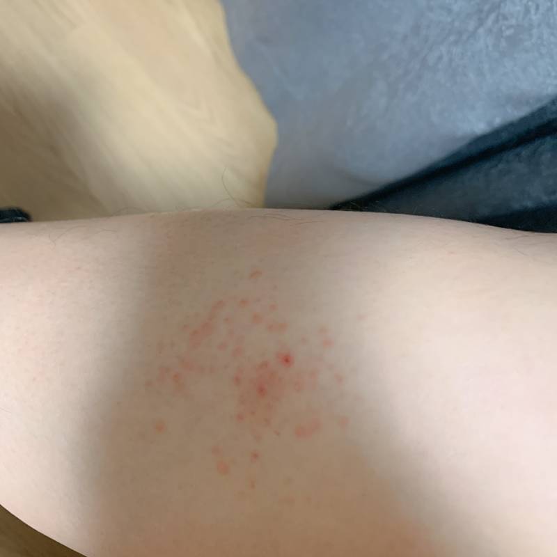 혹시 모기 물리고 이렇게 되본 적 있는 익인 있니ㅠㅠ (혐오주의) | 인스티즈