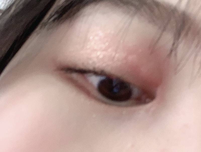 이거 다래끼야? ㅠㅠㅠㅠ사진 | 인스티즈