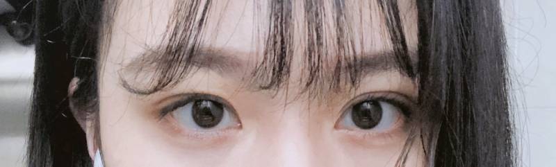 나 짝눈 심해....? 수술할까...? 4040 | 인스티즈