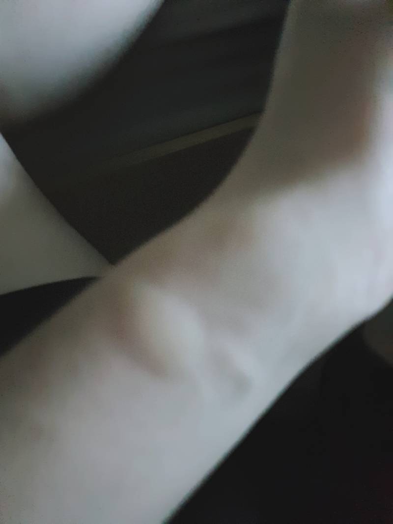 모기물린곳 이렇게 붓기도 해..? | 인스티즈