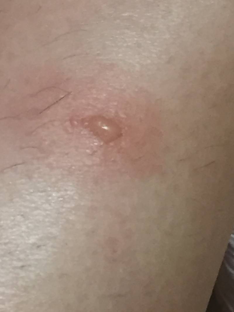 나 이거 모기 물린 거 아니지..? 혐오주의 | 인스티즈