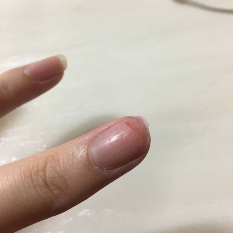 손톱이 바디중앙까지 깨졌는데 어떡해??ㅠㅠ (사진주의 | 인스티즈