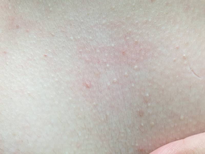 이거 나 피부 왜 이래?ㅜㅜ 피지인가? (혐오주의) | 인스티즈