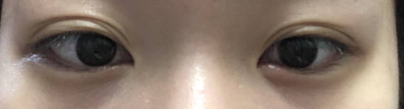 이거 다래끼인가?ㅠㅠ (눈 사진 주의) | 인스티즈