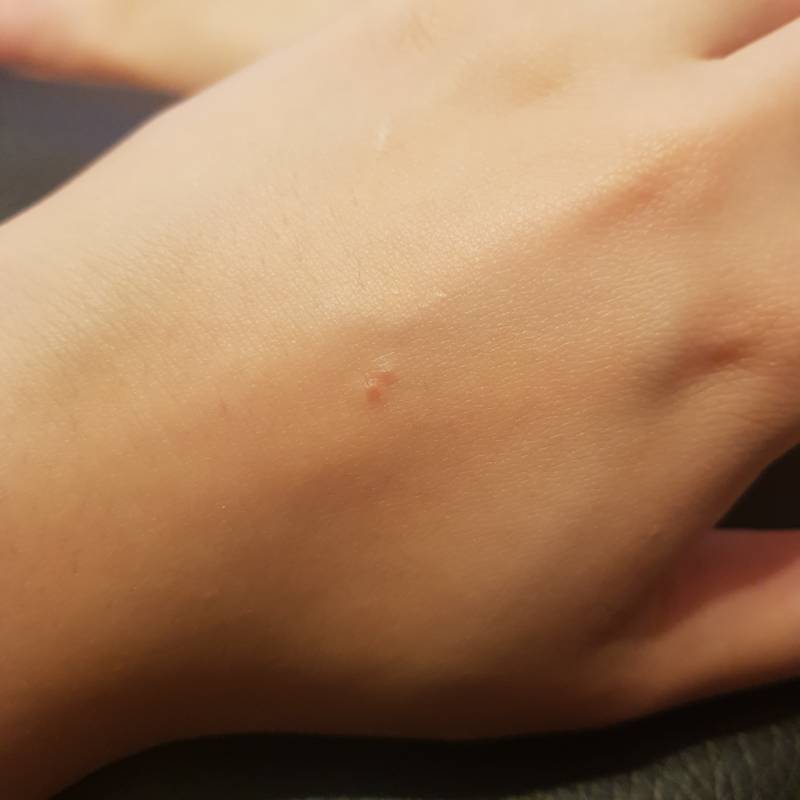 이렇게 물렸는데 개미야?? | 인스티즈