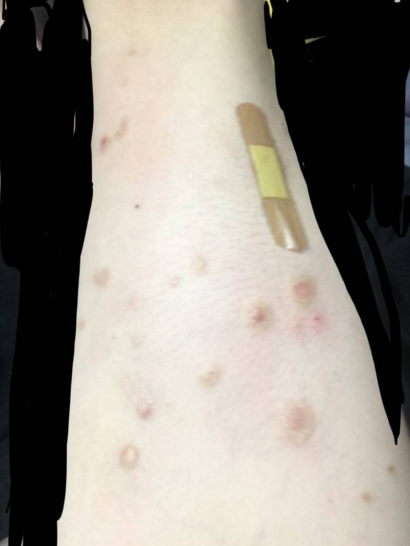 다리 뒤 쪽에 피부병 있거나 피부병 앓아본 익들...(혐오주의) | 인스티즈