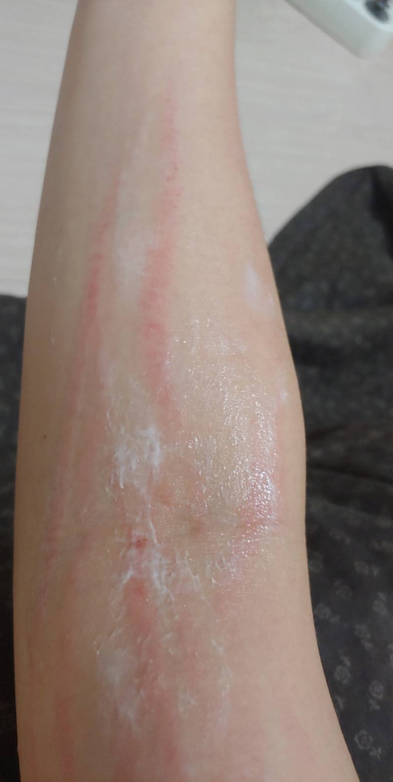 나 이렇게 팔 전체가 할켜진거 어떻게 가려야돼??? | 인스티즈