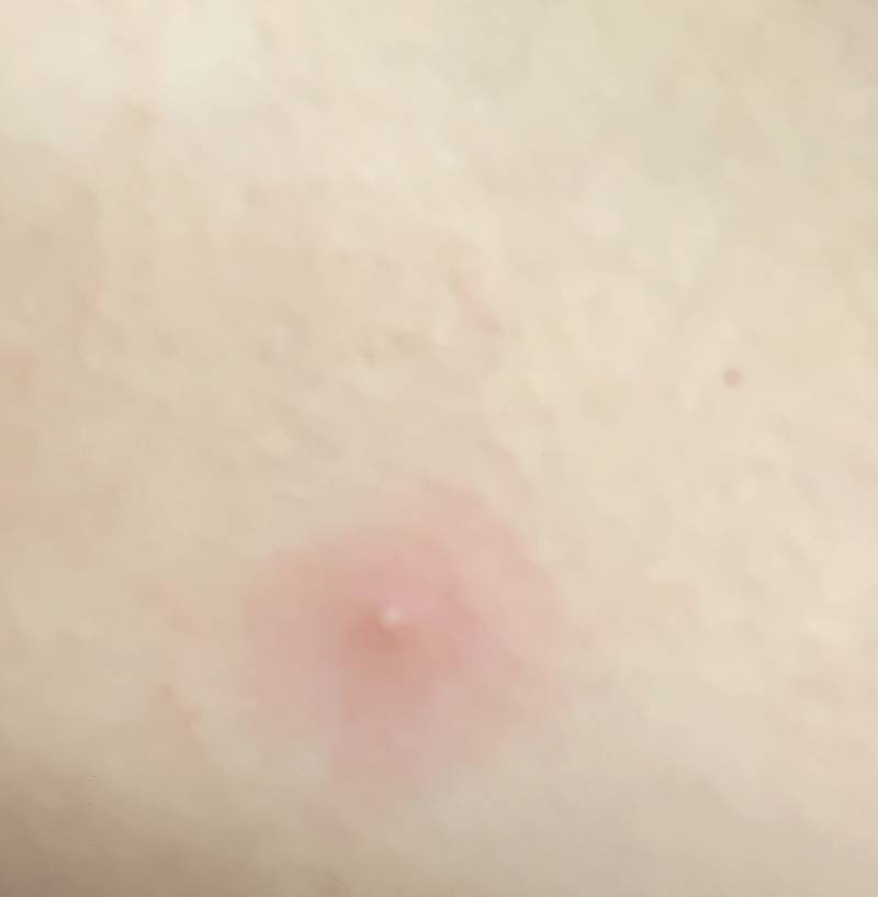 손에 여드름 났어ㅋㅋㅋㅋ 신기하다 | 인스티즈