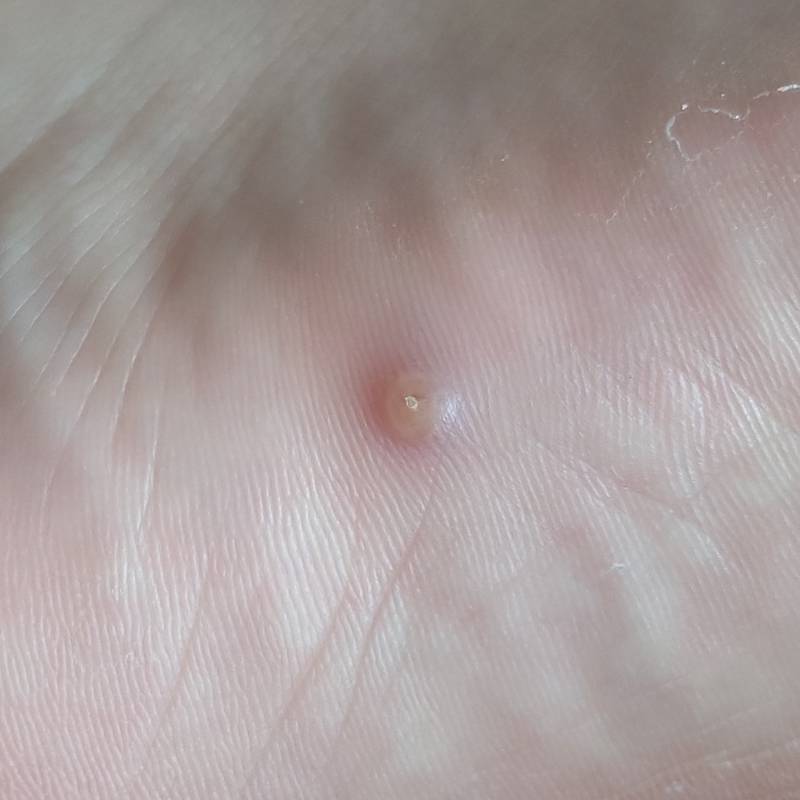 동생 발에 뭐 났는데 이거 뭔지 아는 익...(사진주의) | 인스티즈