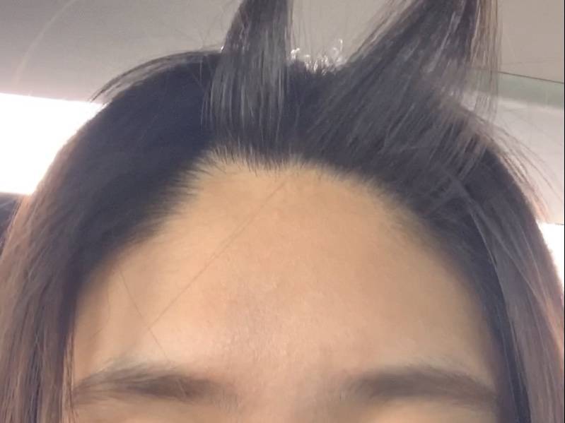 나보다 헤어라인 심한 애 있냐 | 인스티즈