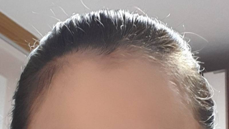 이마라인 정리할까말까 | 인스티즈