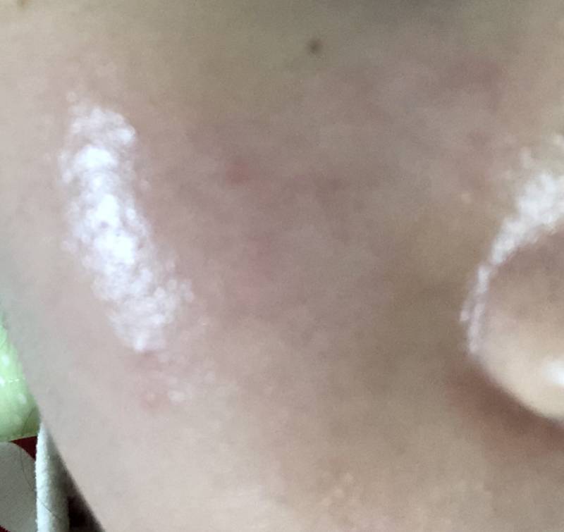 피부가 이렇게 울긋불긋 하고 간지러운데 오늘 선크림도 바르지말까? | 인스티즈