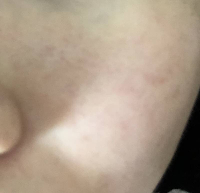 피부가 이렇게 울긋불긋 하고 간지러운데 오늘 선크림도 바르지말까? | 인스티즈