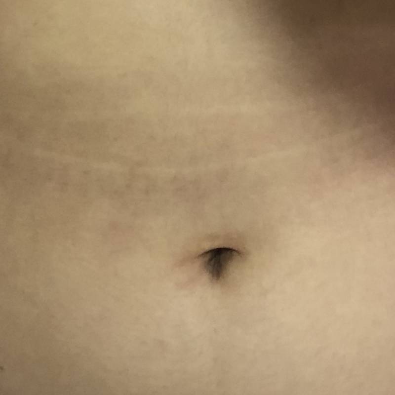 배에 줄같은게 생겼는데ㅜㅜ | 인스티즈