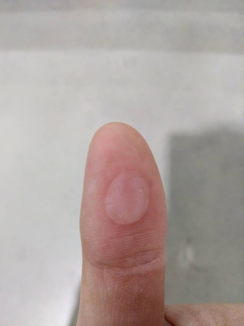 물집 이런거는 터뜨려도 되나? | 인스티즈