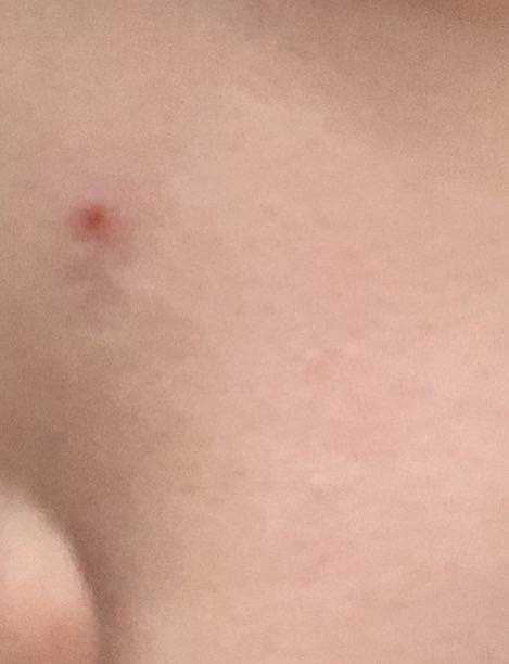 ♨️♨️♨️♨️익들아!!!! 피부잘알들아!!이런 빨갛게 난 거는 짜면 안되지? | 인스티즈