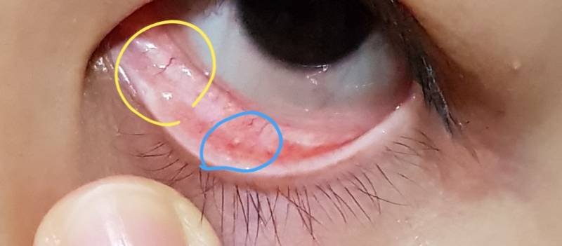 이거 안과 가봐야되나???.. | 인스티즈