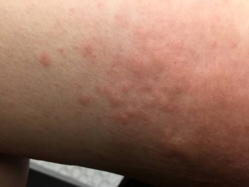 콜린성 두드러기 이거 진짜 사람 미치게 만드는거같아(사진o | 인스티즈