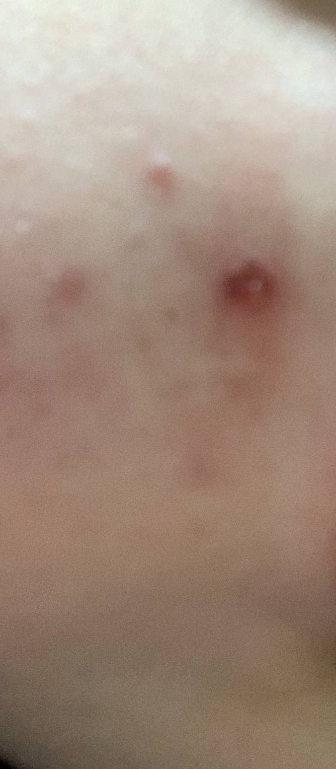 이거 입술아래쪽에 생긴건데 안없어지고 계속 피나ㅠㅠㅠㅠ | 인스티즈