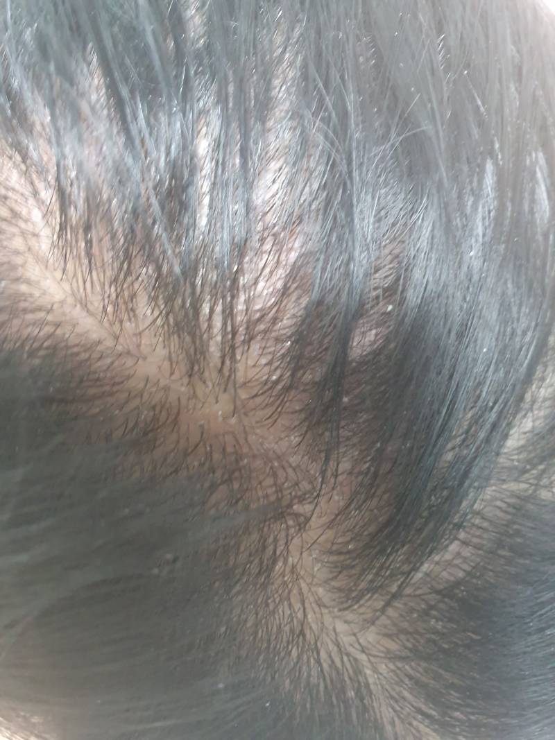 나 요즘 두피 왜 이러지..?ㅠㅠㅠ(혐오주의) | 인스티즈