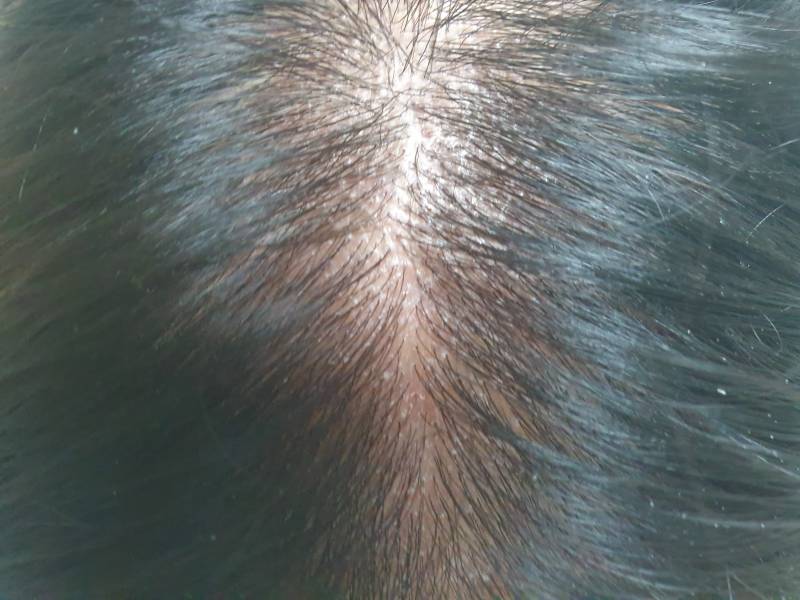 나 요즘 두피 왜 이러지..?ㅠㅠㅠ(혐오주의) | 인스티즈