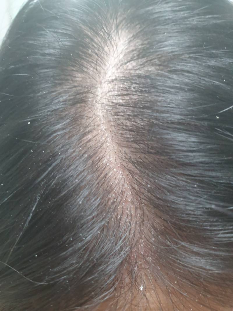 나 요즘 두피 왜 이러지..?ㅠㅠㅠ(혐오주의) | 인스티즈