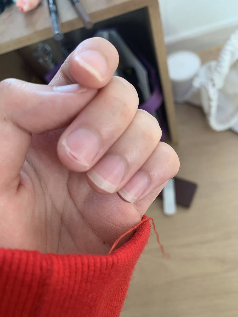 나 손톱이 뜯겼는데 (혐오주의) | 인스티즈