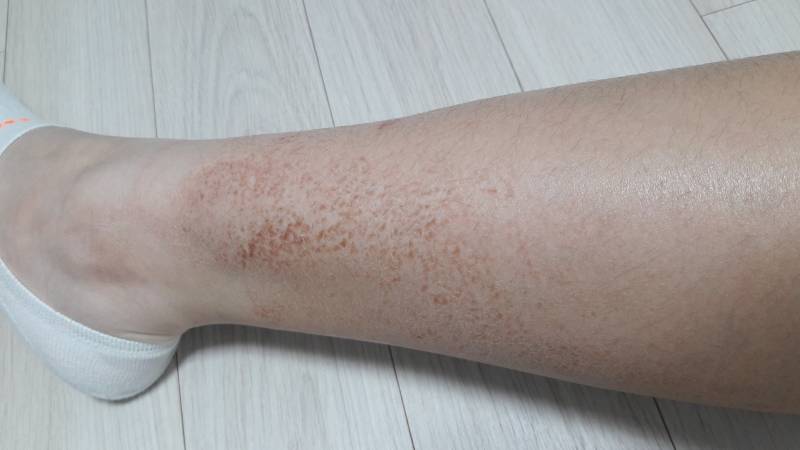 여드름약 먹으면 다리 원래 이렇게돼? | 인스티즈