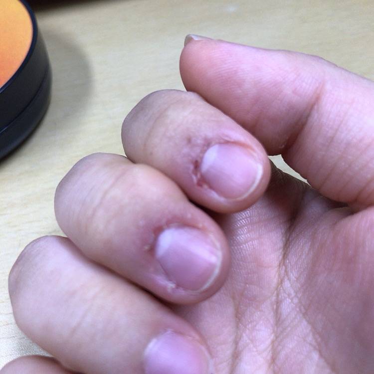 상처딱지나 가시래기는 다 뜯어버려야 직성이 풀리는 쓰니 손 상태.... | 인스티즈