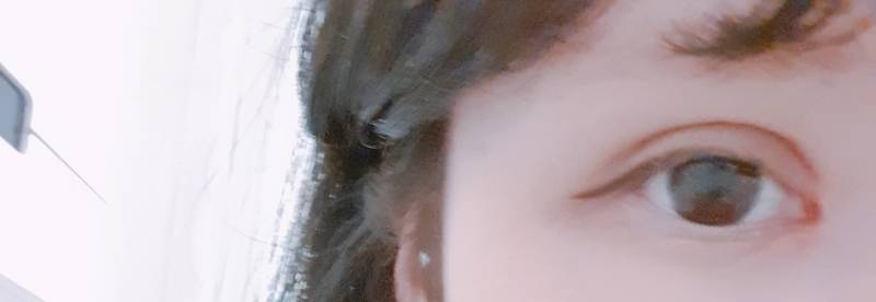 쌍수 한달짼데 만족이안돼 | 인스티즈