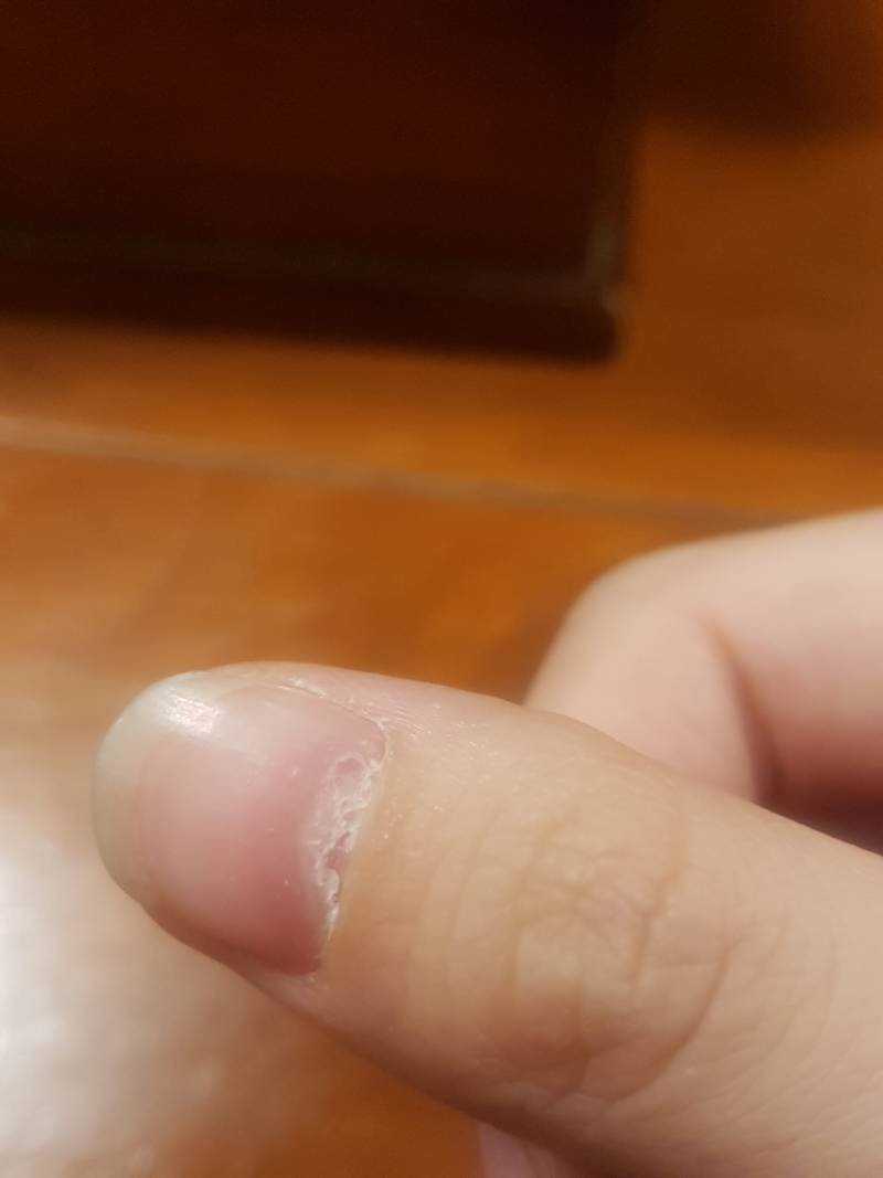 손톱 왜 이러지 ㅠㅠㅠㅠㅠ | 인스티즈