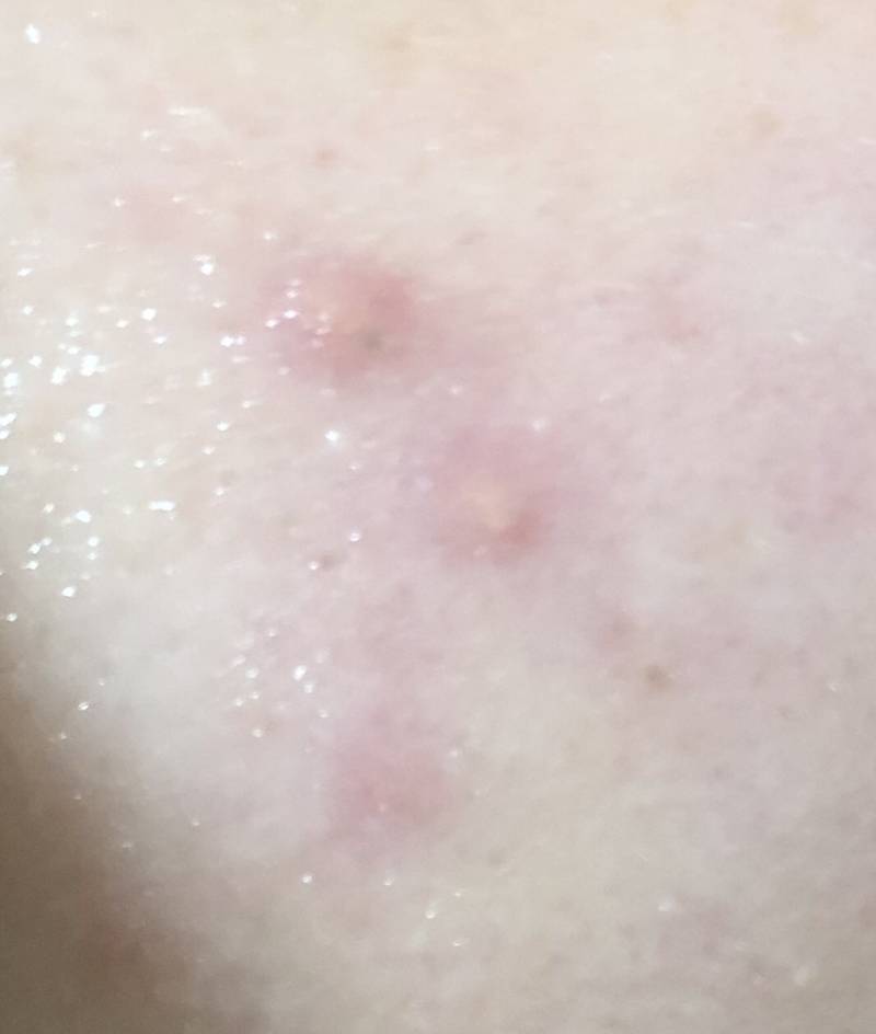 이 여드름 뭐야ㅠㅠㅠㅠ | 인스티즈