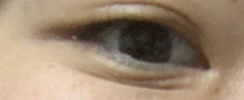 웃을 때마다 눈밑 주름땜에 스트레스 받아 ㅠㅠ | 인스티즈