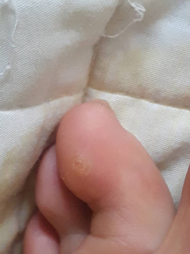 이거는 굳은살이야 ? 티눈이야? (ㅎㅇㅈㅇ) | 인스티즈