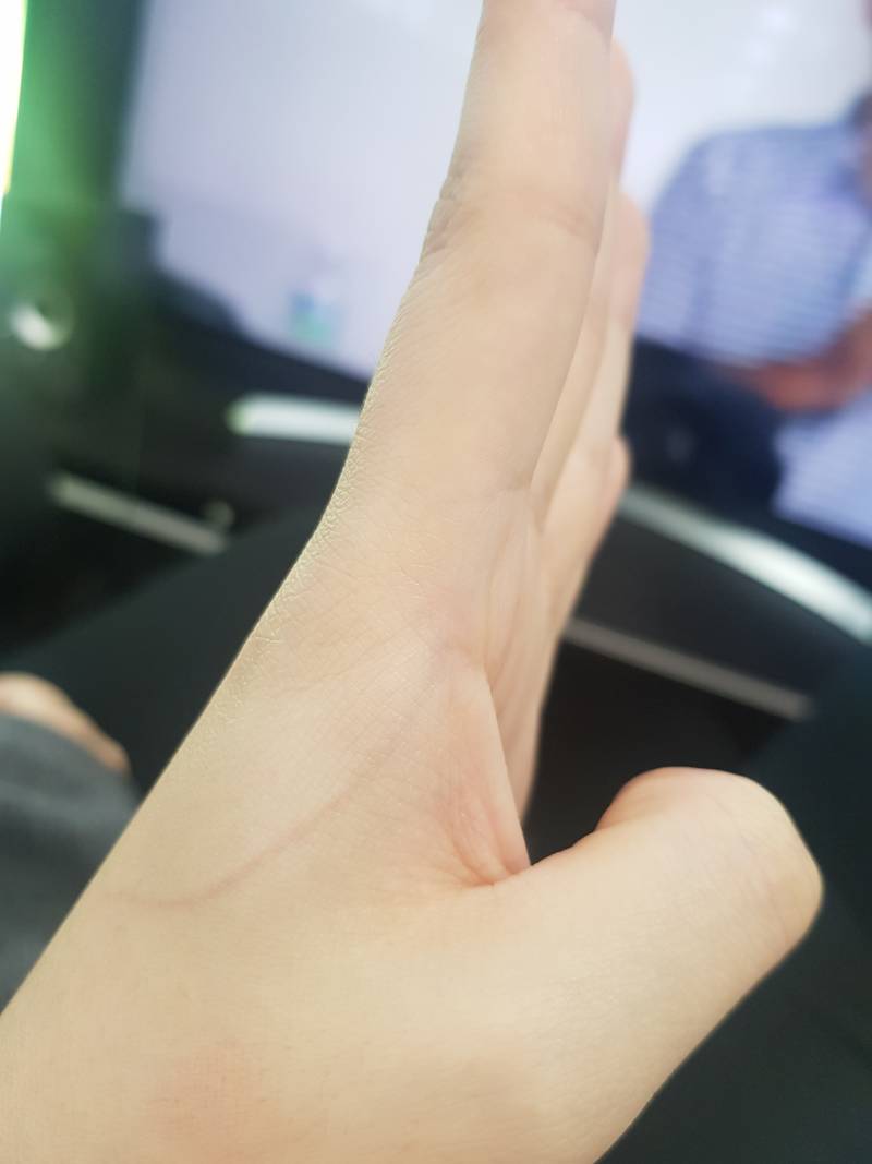 나 핏줄이 이상한데 병원가야 하나??ㅠㅠㅠ | 인스티즈