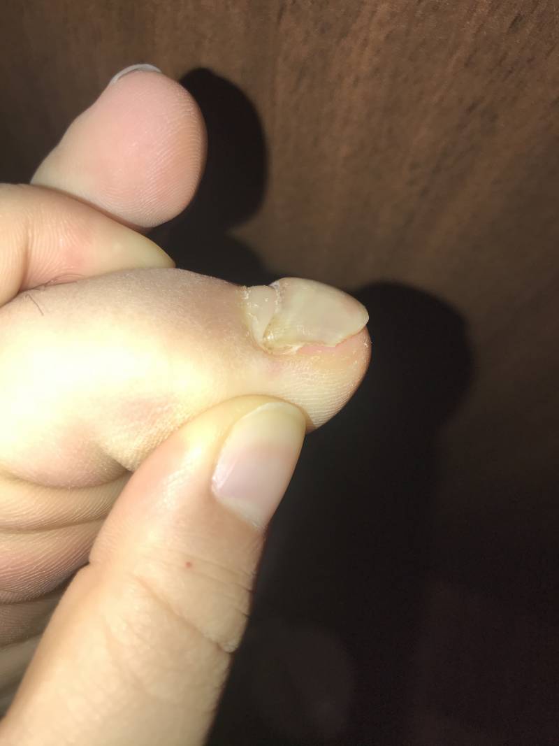 익들아 ㅠㅜ 발톱이...ㅎㅇㅈㅇ | 인스티즈