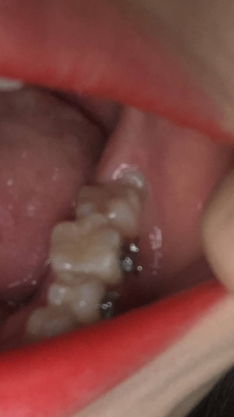 이거 빼야하는 사랑니야 ㅜ? | 인스티즈