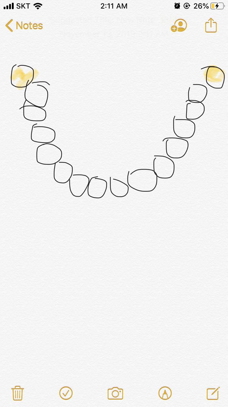 사랑니 이렇게 자라면 매복이야? | 인스티즈