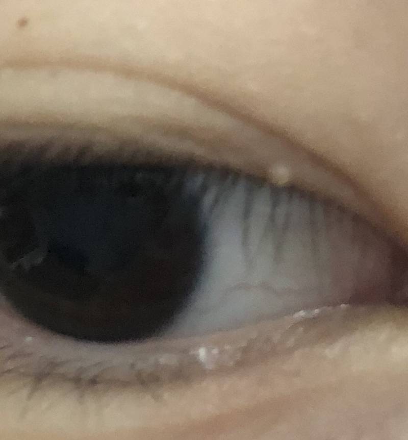 눈꺼풀에 이런 게 있는데 뭘까 | 인스티즈