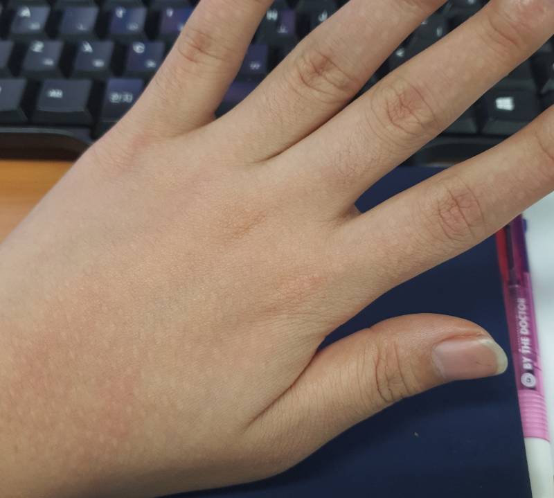 나 방금 손에 뭐 질환가튼거 생긴줄 놀랐어 ㅋㅋㅋㅋㅋㅋ 40 | 인스티즈