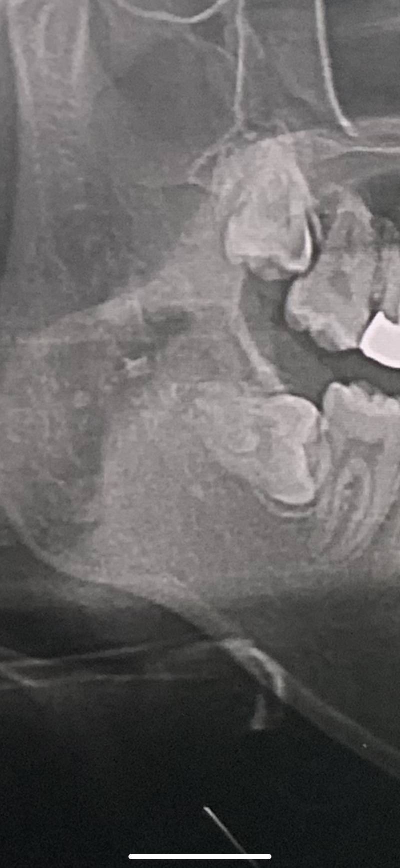 내 사랑니 봐줘 완전 특이하지 않아 ? ㅠㅠ40 | 인스티즈