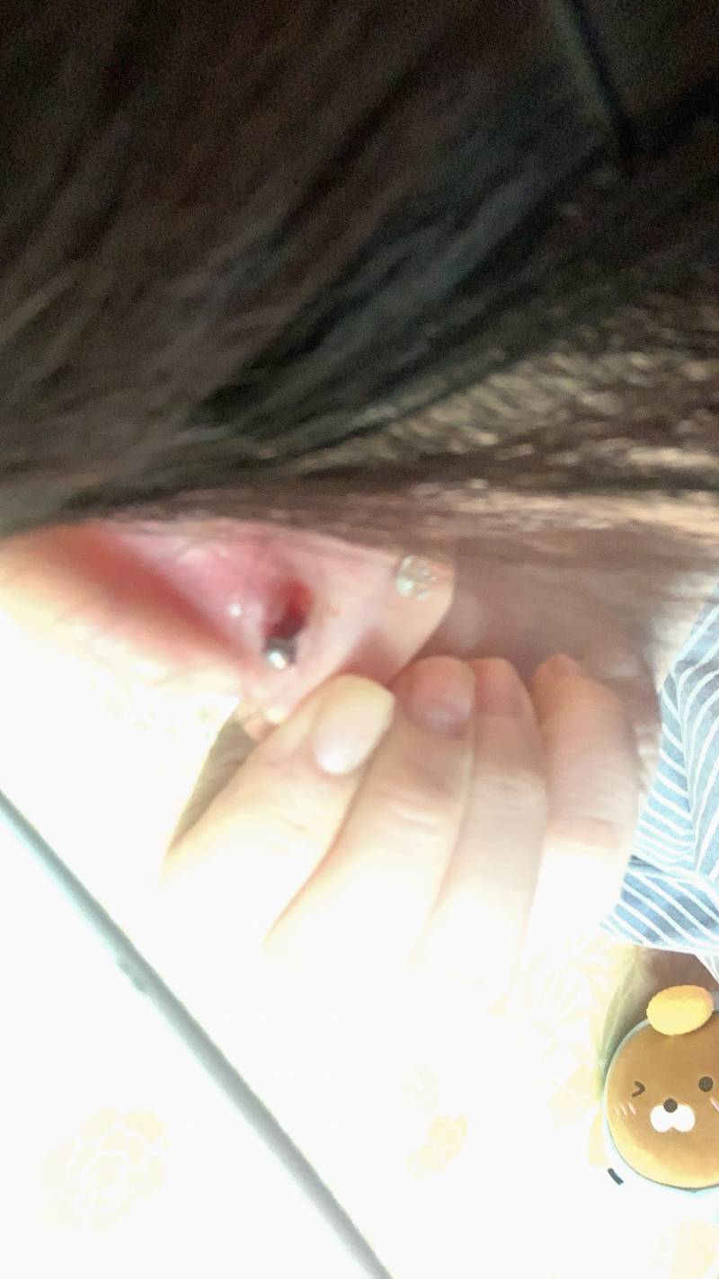 피어싱 염증 나본익들 있ㅇ? 사진 약 ㅎㅇㅈㅇ | 인스티즈