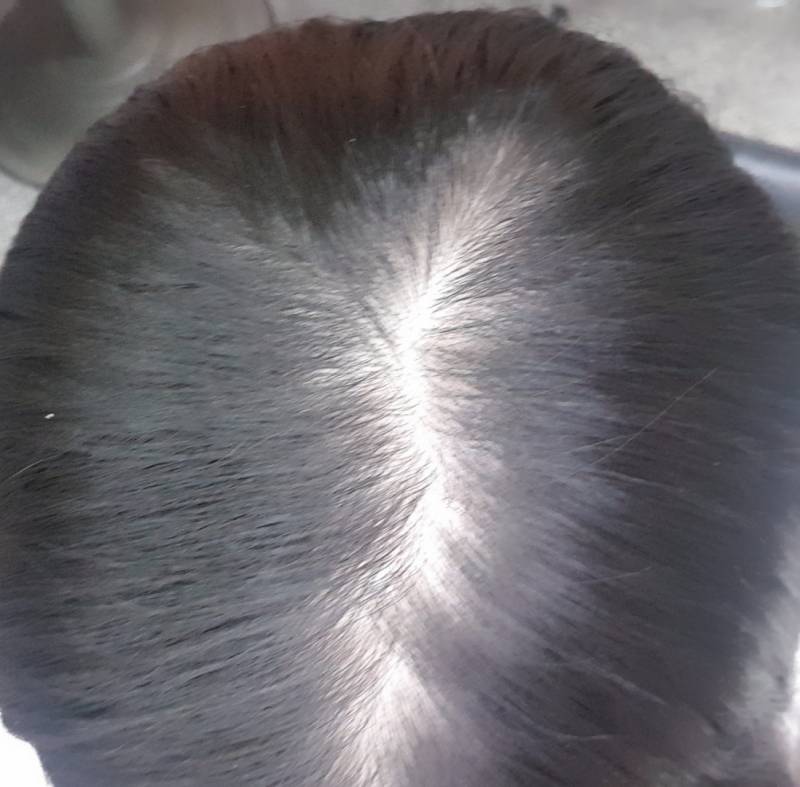 이거 탈모 맞는지 좀 봐줘 | 인스티즈