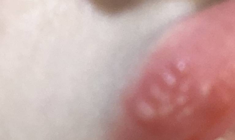 입술에 물집생겻는데 이거뭐야? | 인스티즈