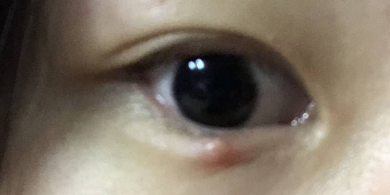 이거 다래끼야??? 아는 사람 제발 알려쥬 ㅠㅠ | 인스티즈