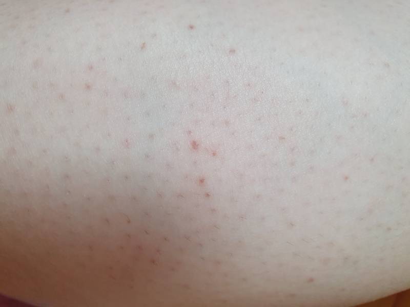 다리 이런거 어떻게 없애....(ㅎㅇㅈㅇ) | 인스티즈