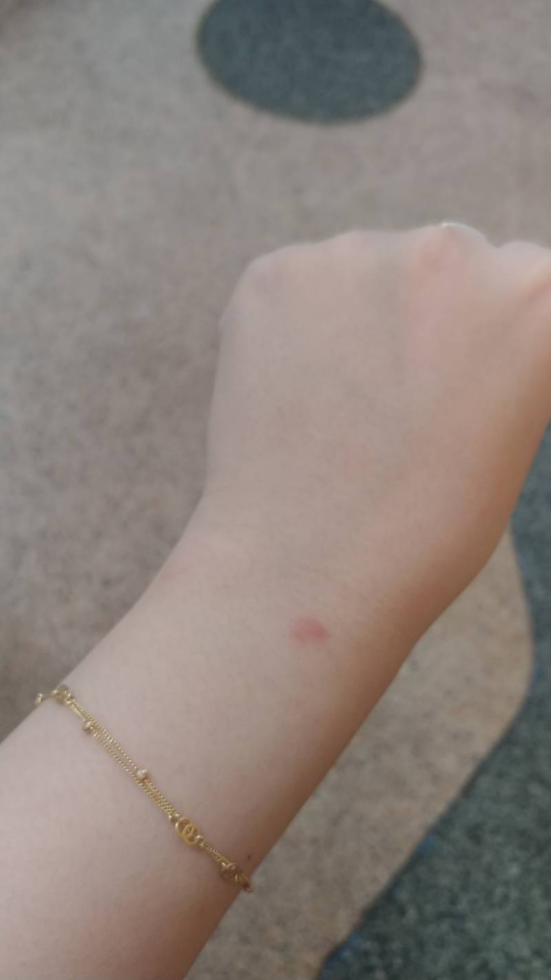 팔에 붉게 반점이 났는데 | 인스티즈