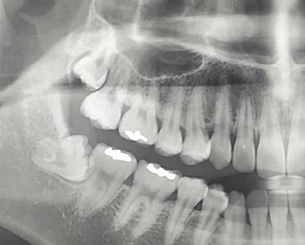 🦷사랑니 뽑아 본 익인이나 사랑니 박사 들어와줘🦷 | 인스티즈